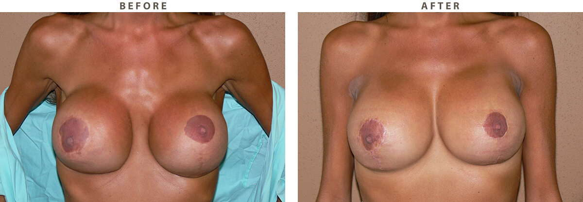 Breast revision Chicago - Before and After Pictures