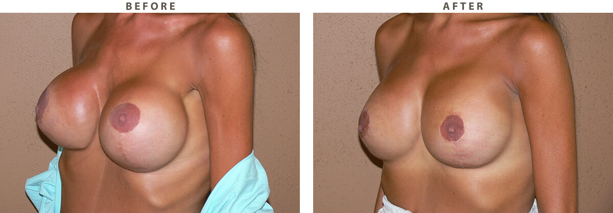 Breast revision Chicago - Before and After Pictures