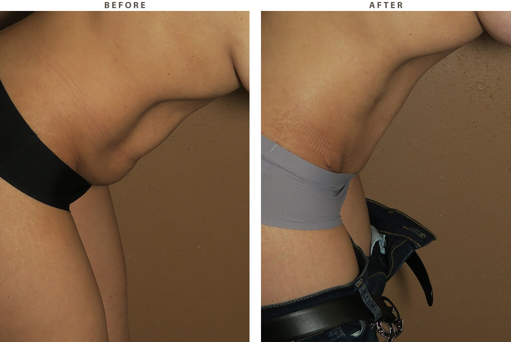 Abdominoplastyn Chicago - Before and After Pictures