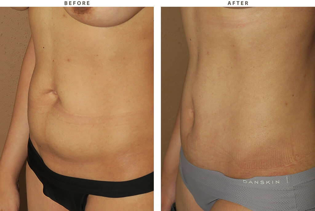 Abdominoplastyn Chicago - Before and After Pictures