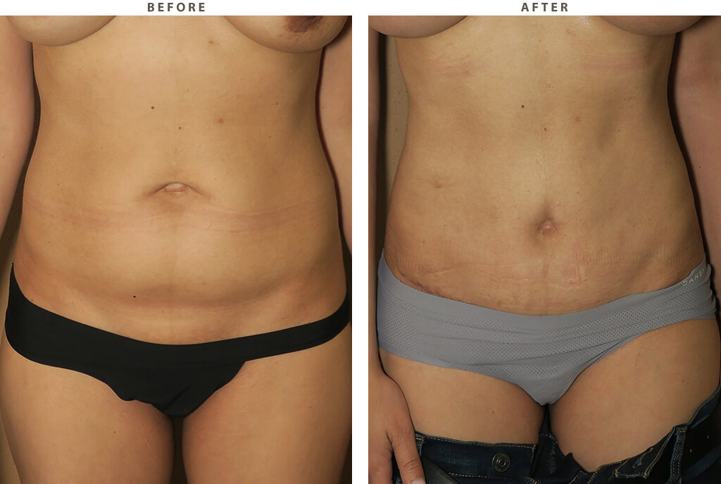 Abdominoplastyn Chicago - Before and After Pictures