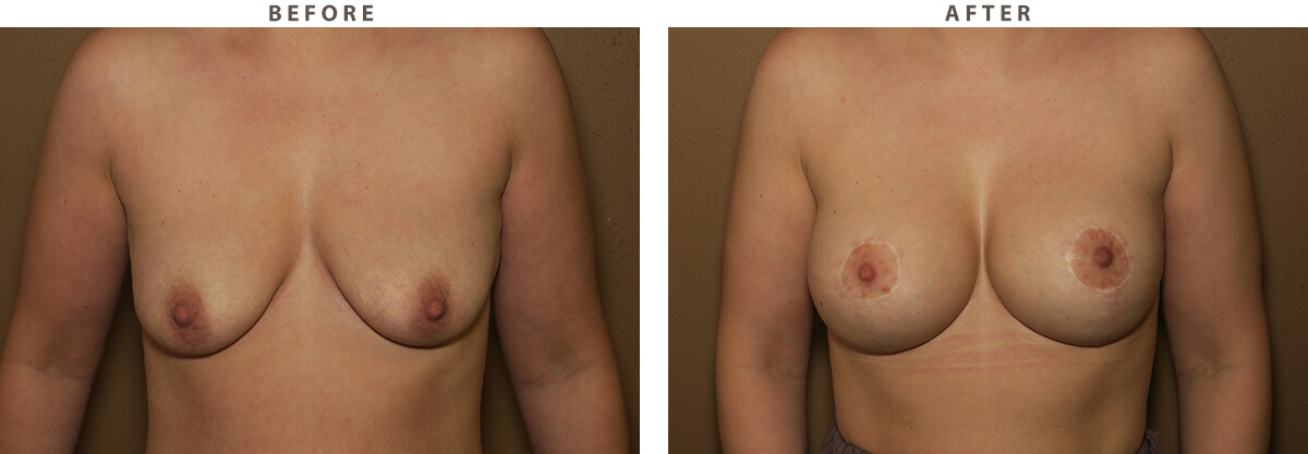 Mastopexy Chicago - Before and After Pictures