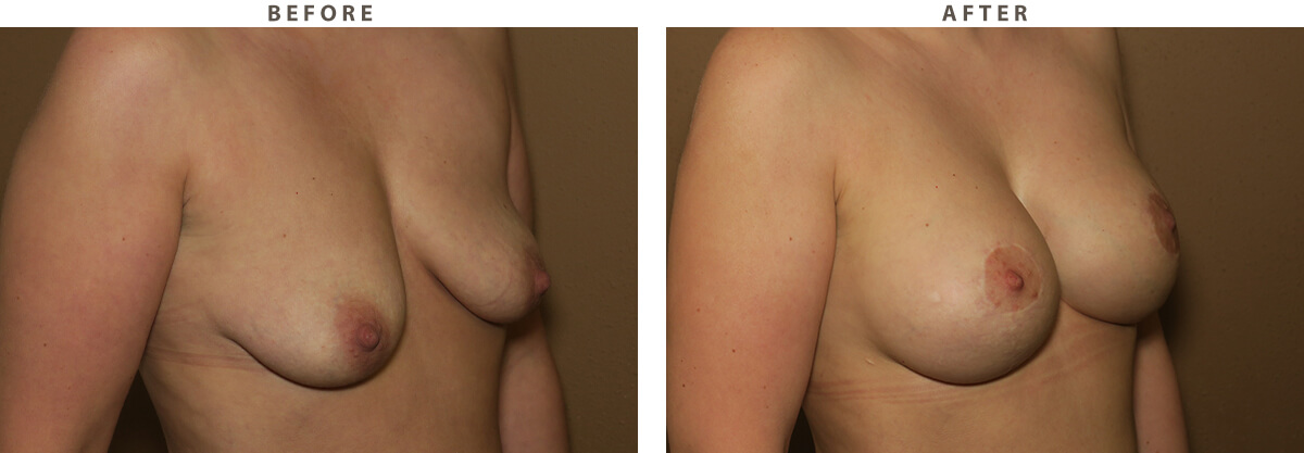 Mastopexy Chicago - Before and After Pictures