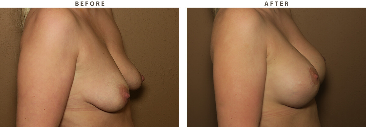 Mastopexy Chicago - Before and After Pictures