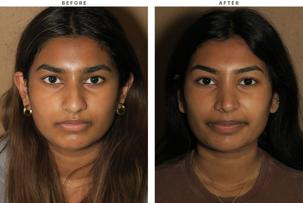 Rhinoplasty Chicago - Before and After Pictures