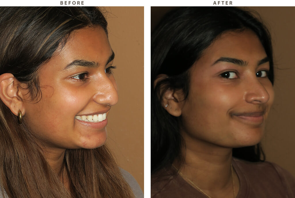 Rhinoplasty Chicago - Before and After Pictures