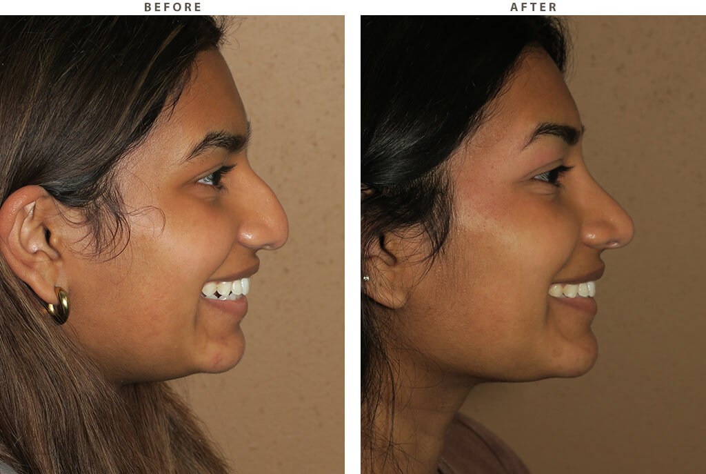 Rhinoplasty Chicago - Before and After Pictures