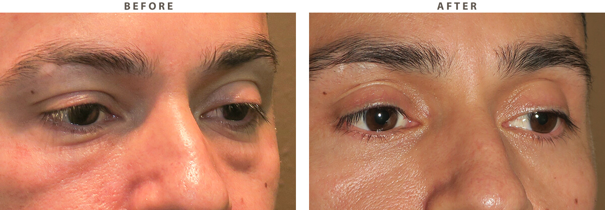 Blepharoplasty Chicago - Before and After Pictures