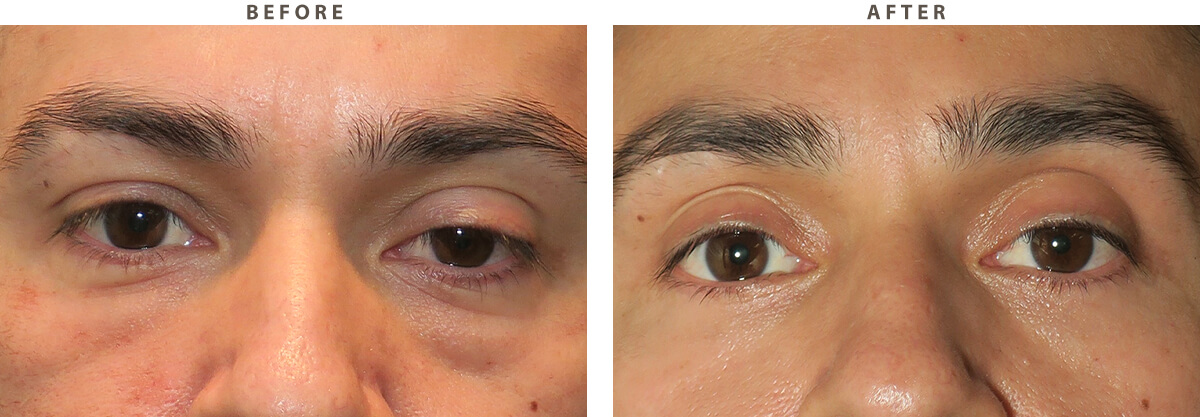 Blepharoplasty Chicago - Before and After Pictures