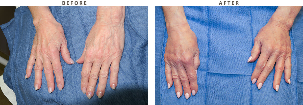 Hand Rejuvenation Chicago - Before and After Pictures