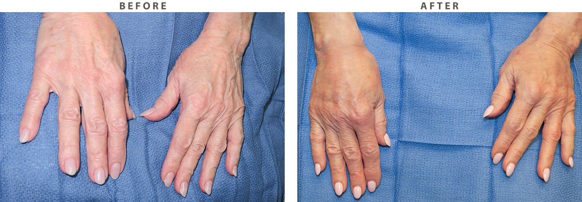 Hand Rejuvenation Chicago - Before and After Pictures