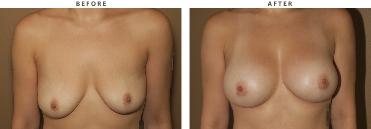 Breast augmentation Chicago - Before and After Pictures