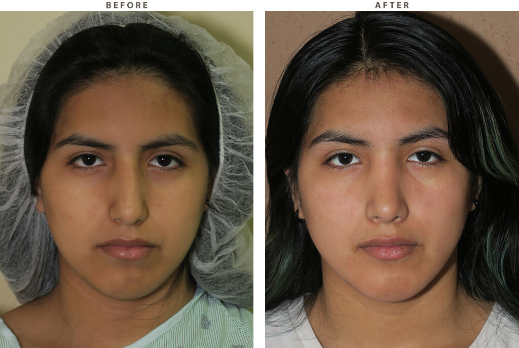 Rhinoplasty Chicago - Before and After Pictures