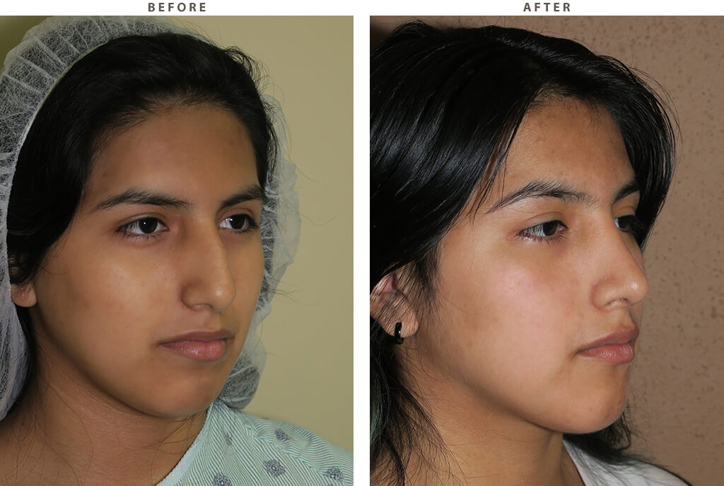 Rhinoplasty Chicago - Before and After Pictures