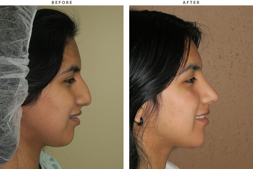 Rhinoplasty Chicago - Before and After Pictures