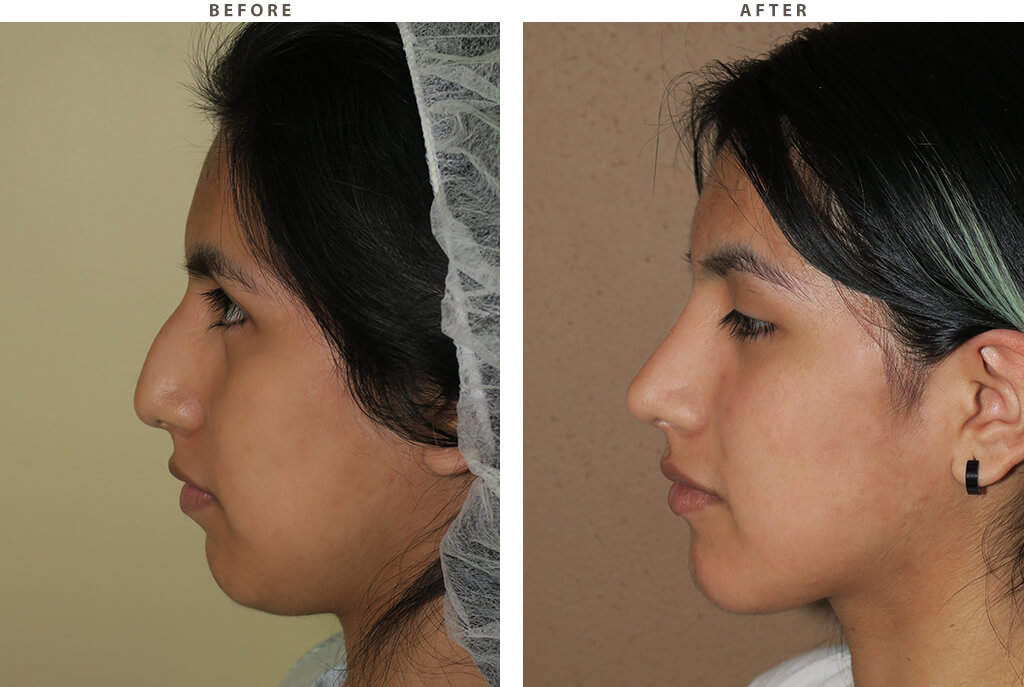 Rhinoplasty Chicago - Before and After Pictures