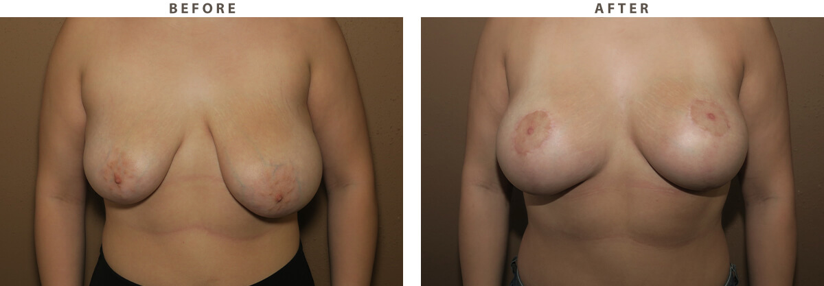 Breast lift Chicago - Before and After Pictures