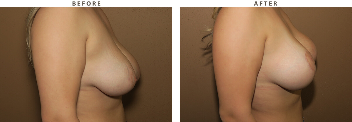 Breast lift Chicago - Before and After Pictures