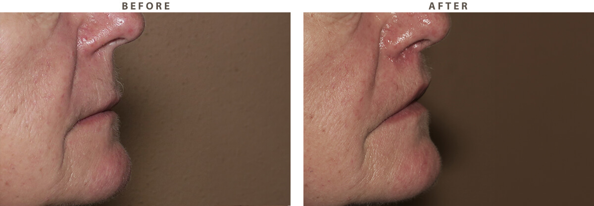 Lip lift Chicago - Before and After Pictures