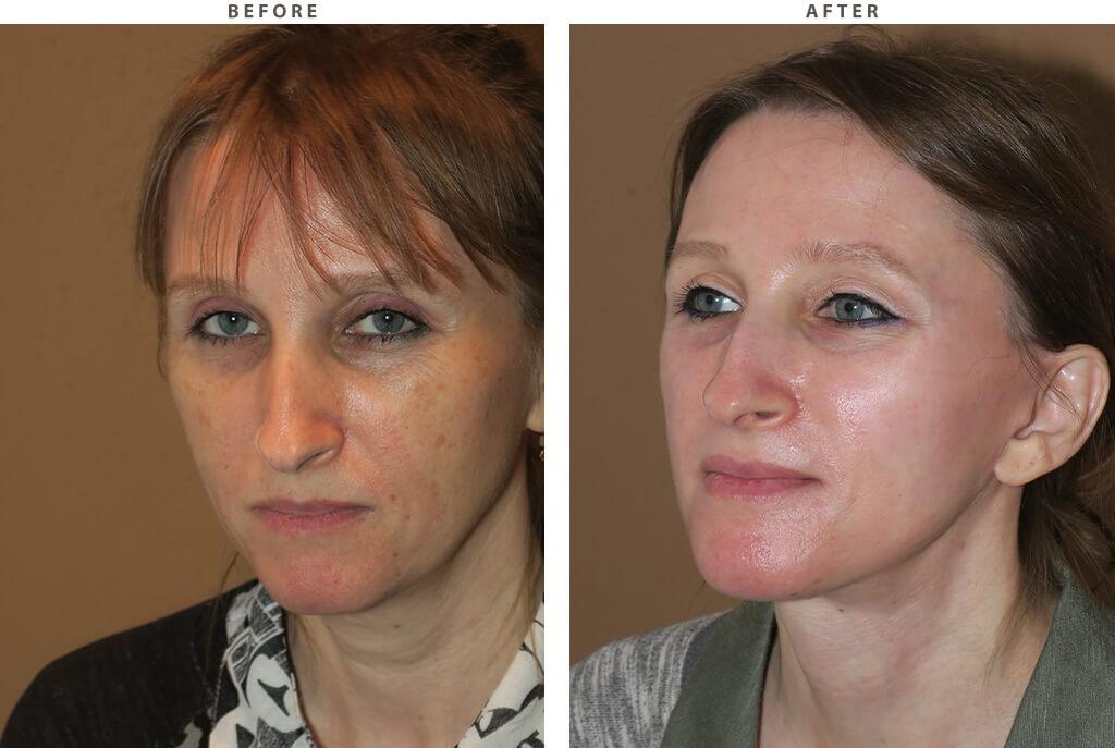 Laser resurfacing - Before and After Pictures