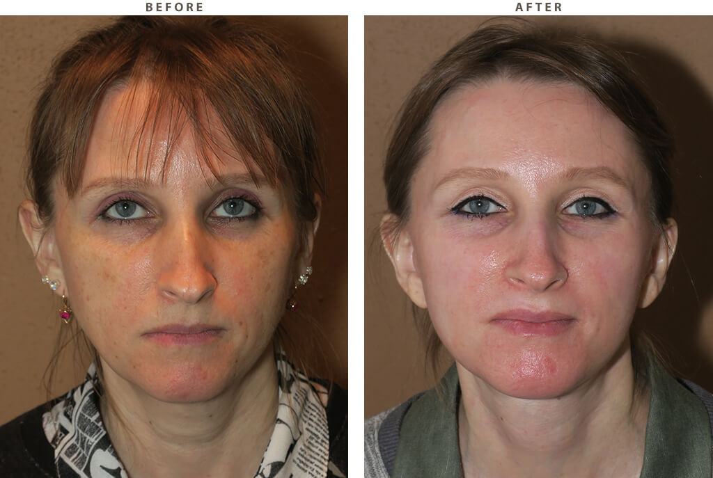 Laser resurfacing - Before and After Pictures