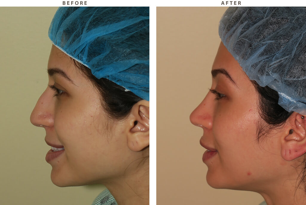 Rhinoplasty - Before and After Pictures