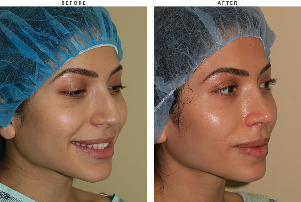 Rhinoplasty - Before and After Pictures