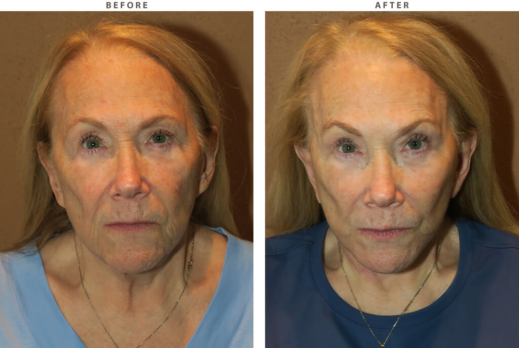 Facelift Chicago - Before and After Pictures