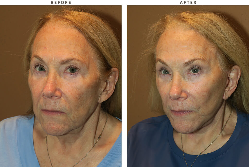 Facelift Chicago - Before and After Pictures