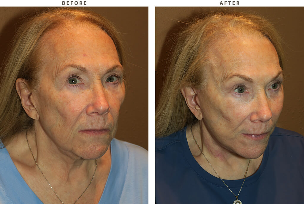 Facelift Chicago - Before and After Pictures