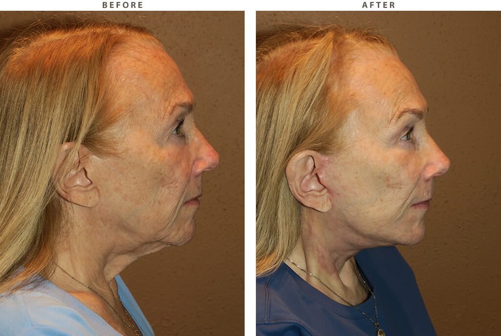 Facelift Chicago - Before and After Pictures