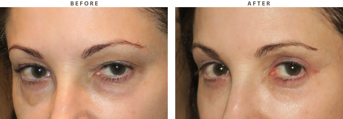 Blepharoplasty Chicago - Before and After Pictures