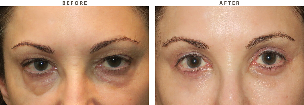 Blepharoplasty Chicago - Before and After Pictures