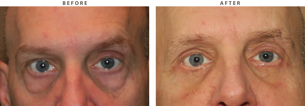 Blepharoplasty Chicago - Before and After Pictures