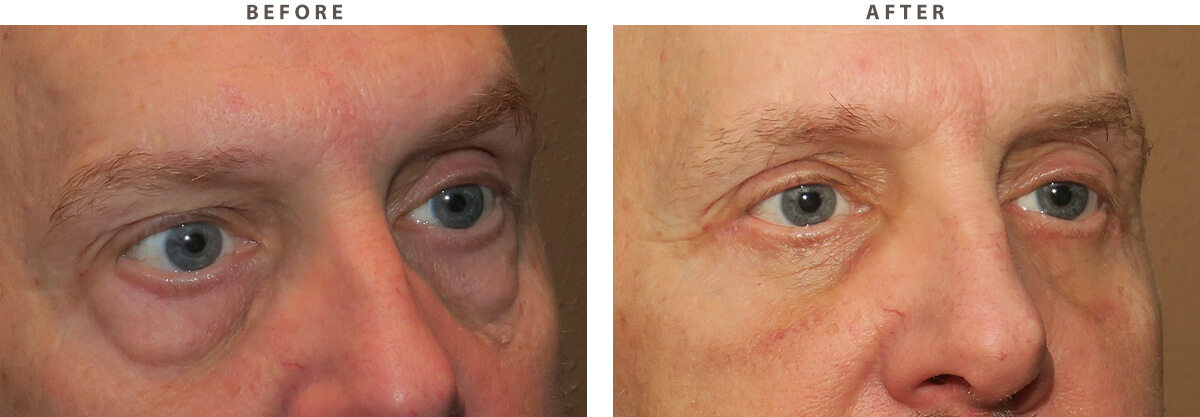 Blepharoplasty Chicago - Before and After Pictures