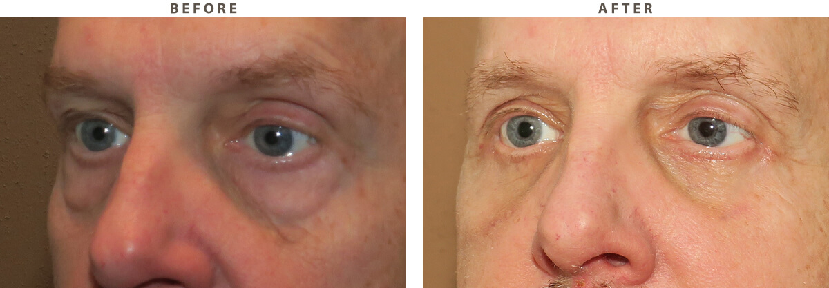 Blepharoplasty Chicago - Before and After Pictures