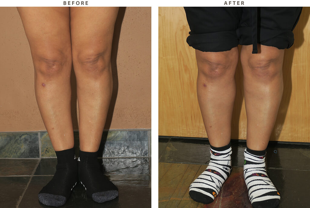 Calf augmentation Chicago - Before and After Pictures