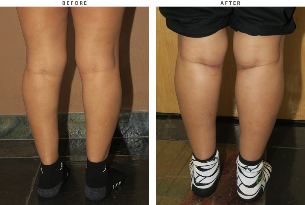 Calf augmentation Chicago - Before and After Pictures