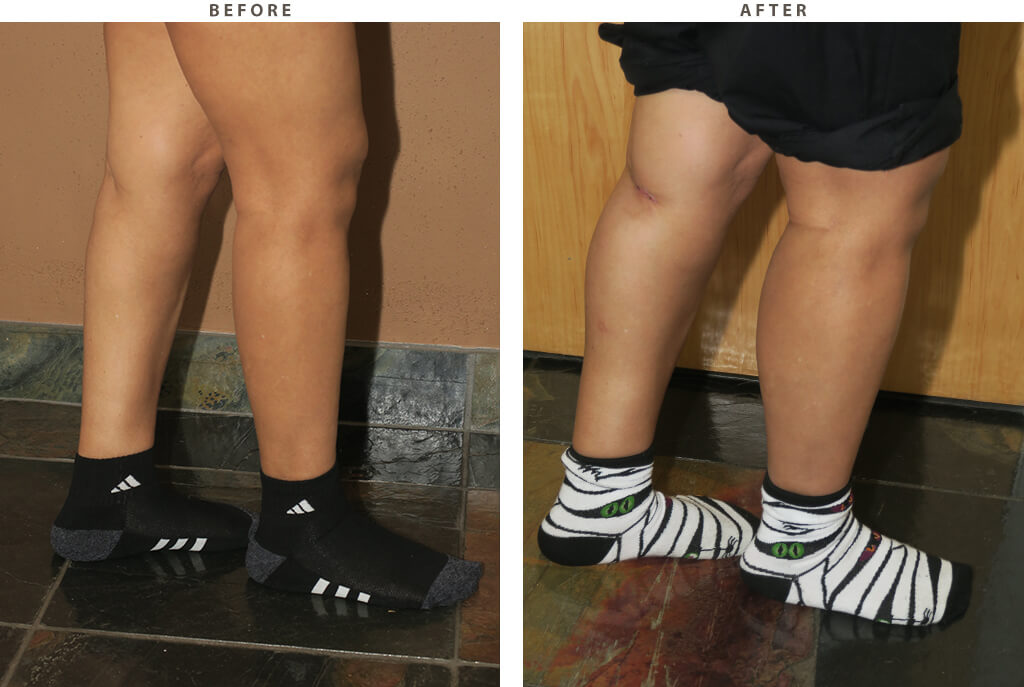 Calf augmentation Chicago - Before and After Pictures