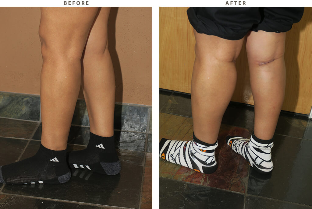 Calf augmentation Chicago - Before and After Pictures