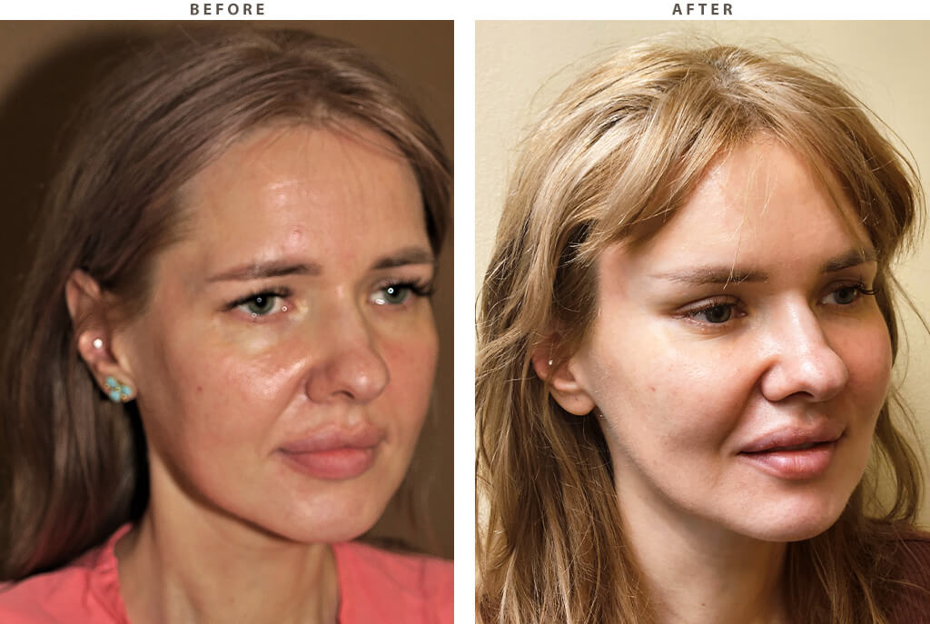 Endobrow midface lift Chicago - Before and After Pictures