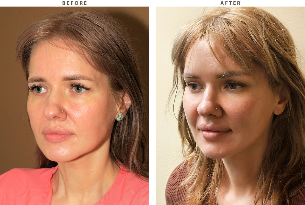 Endobrow midface lift Chicago - Before and After Pictures