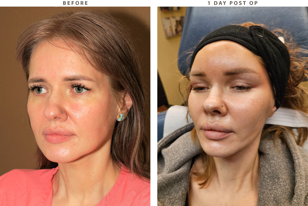 Endobrow midface lift Chicago - Before and After Pictures