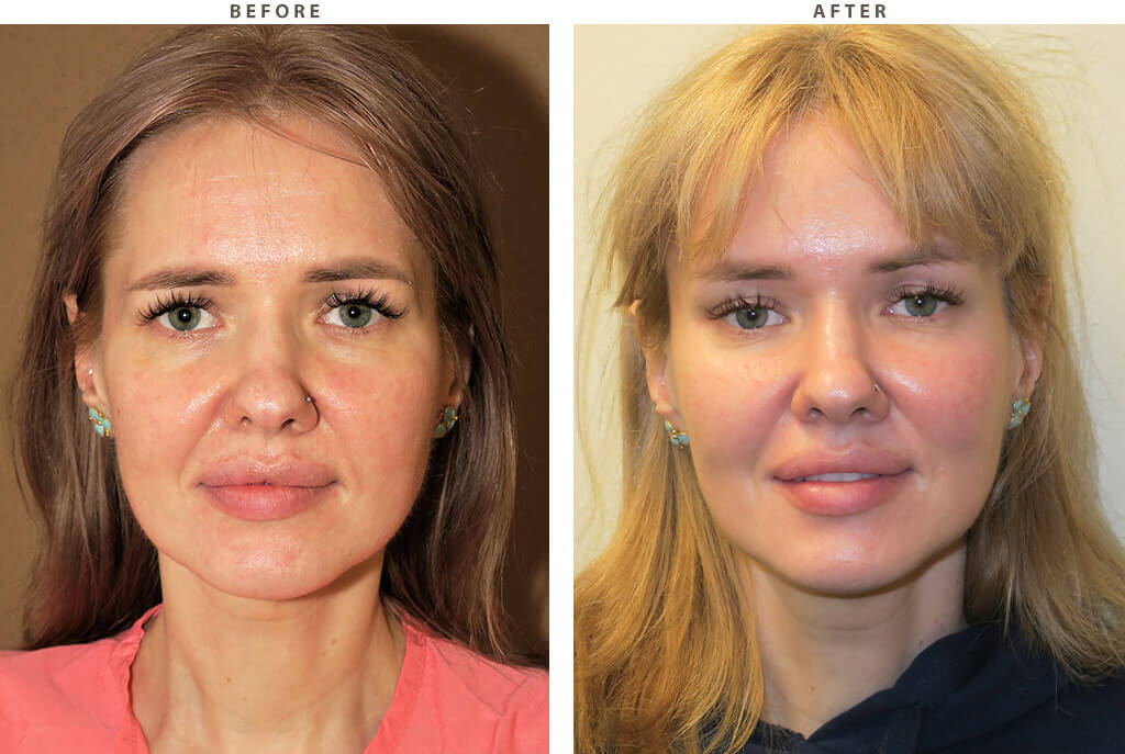 Endobrow midface lift Chicago - Before and After Pictures