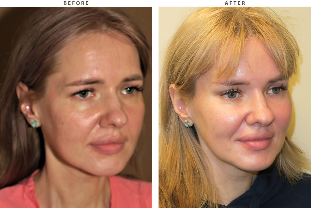 Endobrow midface lift Chicago - Before and After Pictures