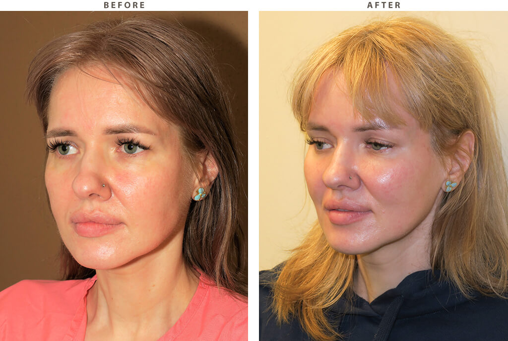 Endobrow midface lift Chicago - Before and After Pictures