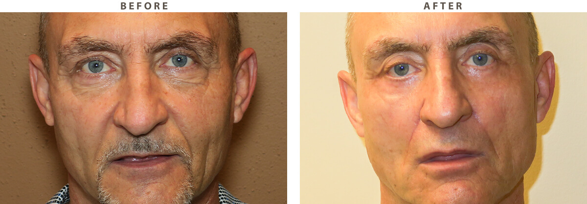Blepharoplasty Chicago - Before and After Pictures