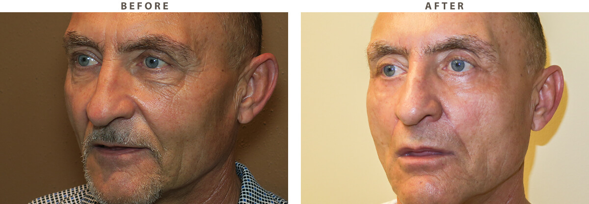 Blepharoplasty Chicago - Before and After Pictures