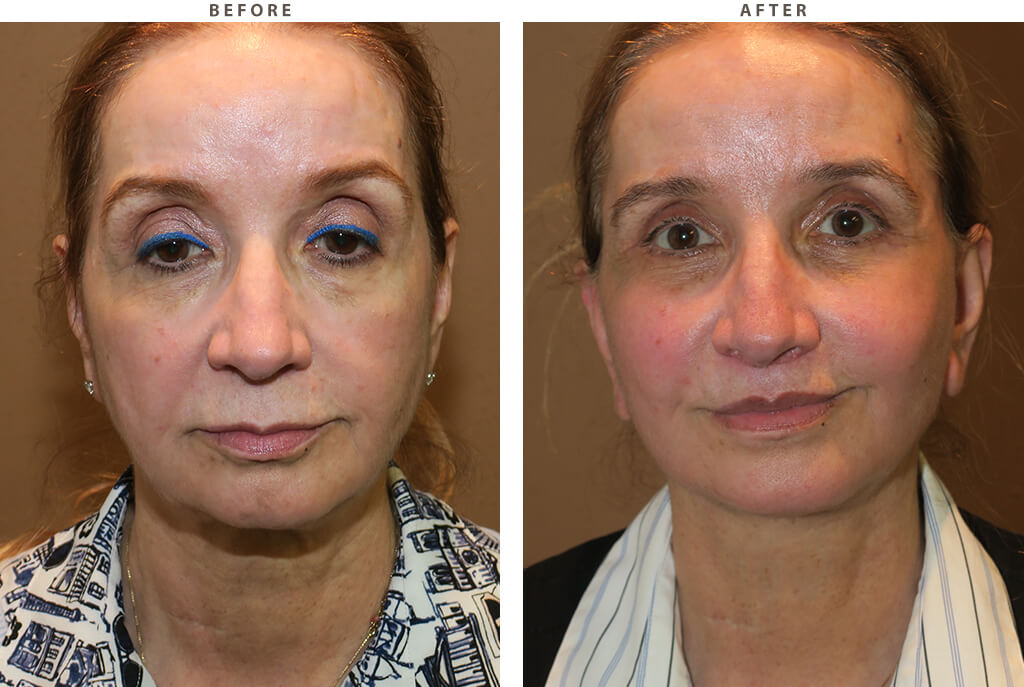 Midface lift Chicago - Before and After Pictures