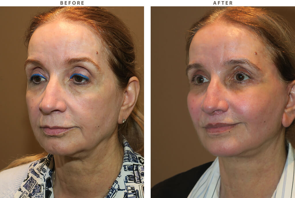 Midface lift Chicago - Before and After Pictures